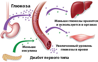 Сахарный диабет 1 типа: причины и признаки