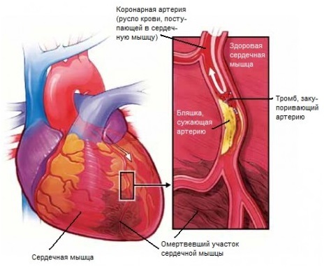 Как отличить сердечную боль от остеохондроза