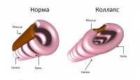 Первая помощь при острой сосудистой недостаточности