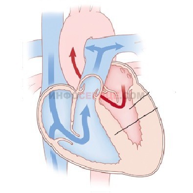 Нагрузка на левое предсердие - Все про гипертонию