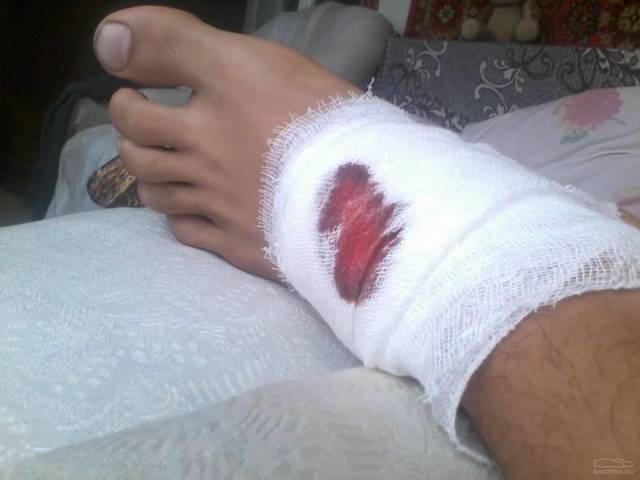 Трофическая язва - причины, симптомы, лечение, профилактика