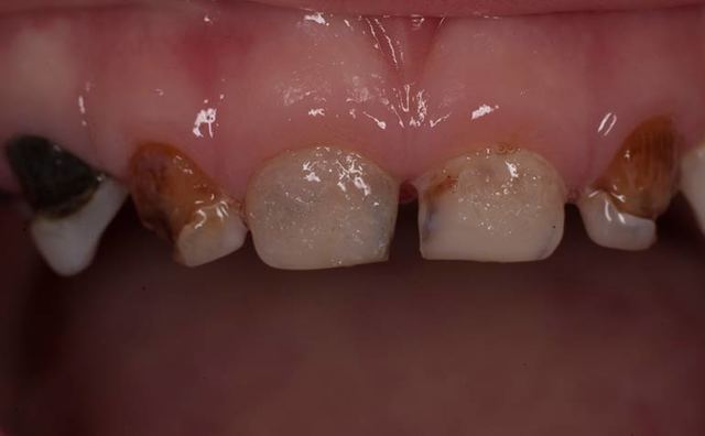 Пришеечный кариес - причины, симптомы, диагностика и лечение