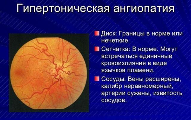 Ангиопатия сетчатки обоих глаз - что это такое и как лечить?
