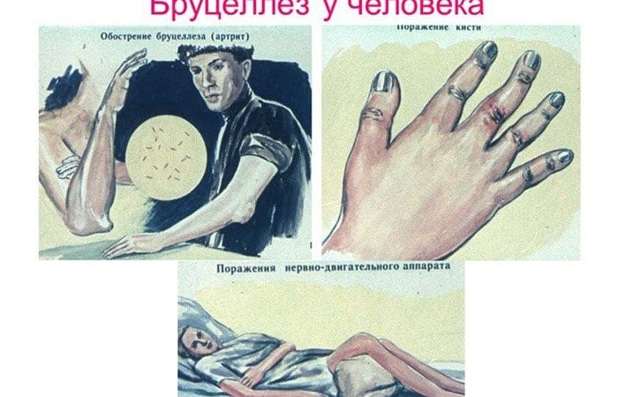 Бруцеллез: что это, симптомы у человека, лечение, диагностика