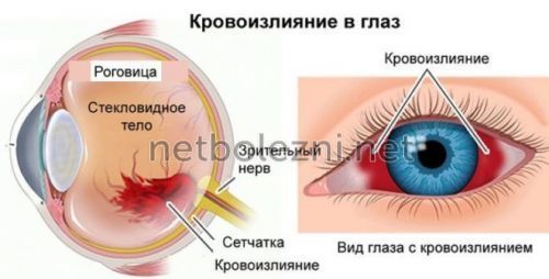 Почему лопнул капилляр в глазу, что делать?