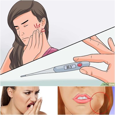 Острый, язвенно-некротический гингивит Венсана: лечение, симптомы и диагностика