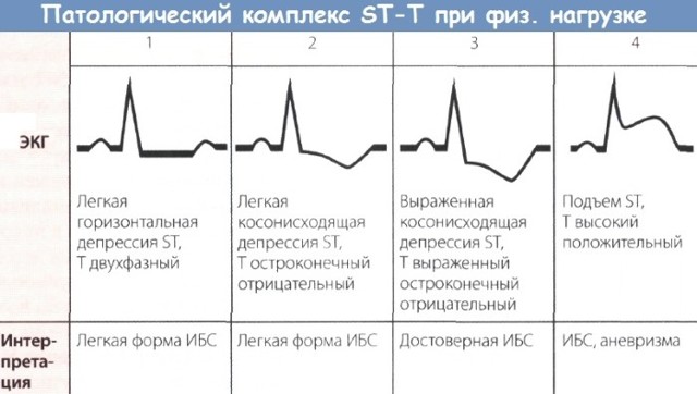 Холтеровское мониторирование экг что это такое — Сердце