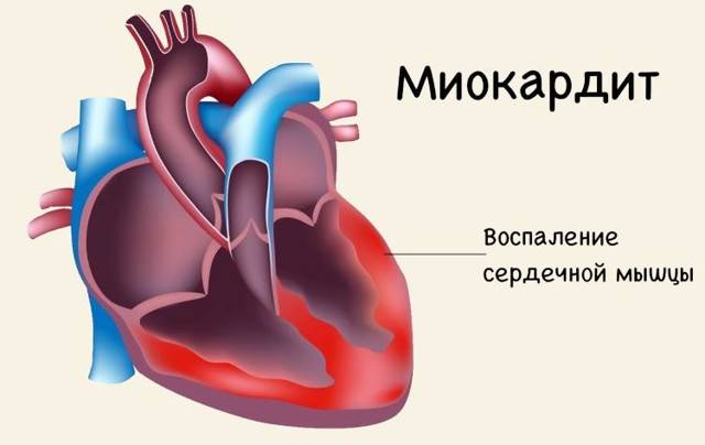 Давящая боль в области сердца