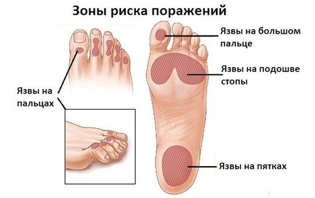 Гангрена при сахарном диабете - причины, признаки и лечение