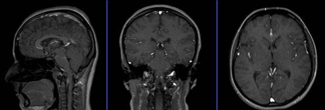 Ангиография (МРА) головного мозга. Личный опыт