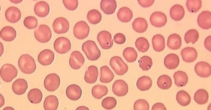 Пароксизмальная холодовая гемоглобинурия. Гемолитические анемии на почве изоиммунных тел.