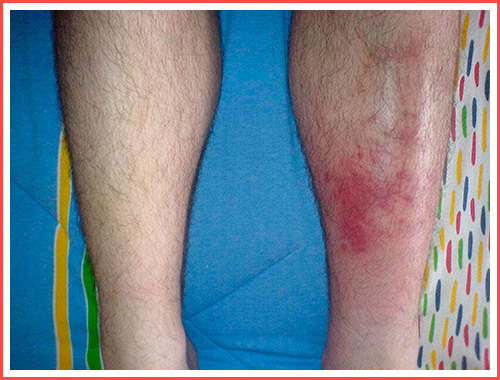 Рожа на ноге фото начальная стадия: Как начинается? - BadAcne