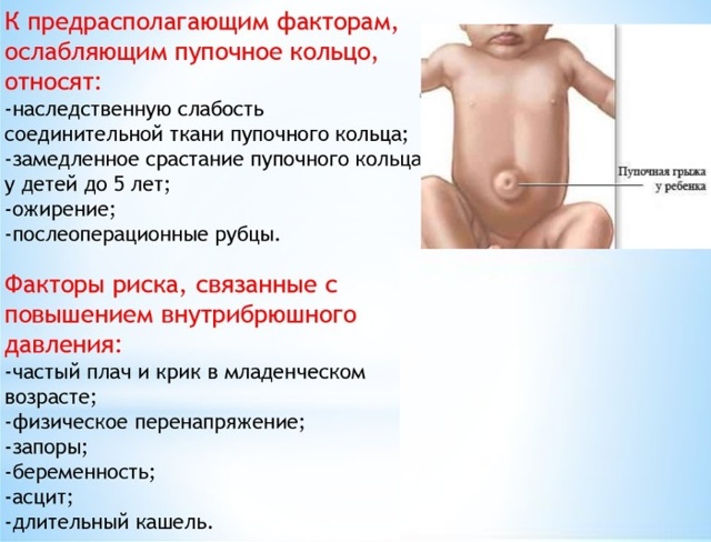 Пупочная грыжа у детей: фото, лечение и симптомы у детей