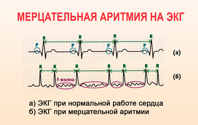 Тахикардия - симптомы и лечение приступов болезни медикаментозными и народными средствами