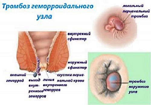 Удаление геморроидальных узлов с помощью разнообразных методик