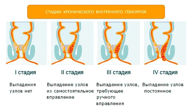 Первая стадия геморроя: лечение, причины, симптомы