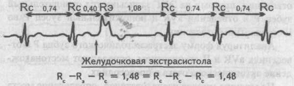 Монотопные экстрасистолы