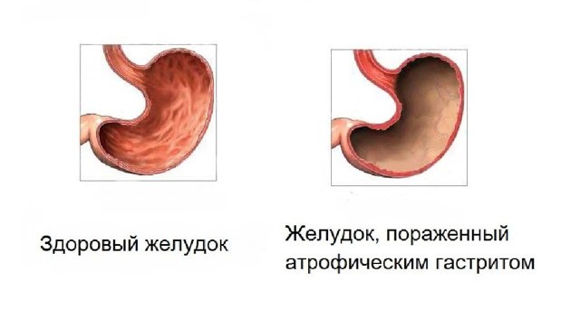 Хронический атрофический гастрит симптомы и лечение у взрослых