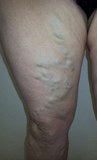 Варикозное расширение вен чем опасно на сайте варикоз