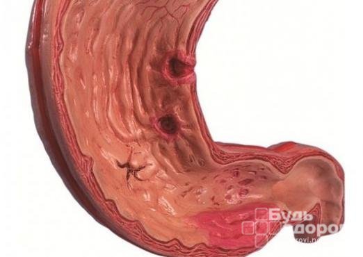 Эрозивный гастрит – симптомы, лечение, диета, осложнения, профилактика