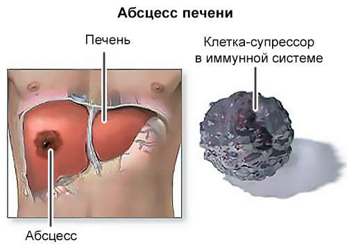Эмболия: что это такое, ее виды и причины, диагностика, лечение