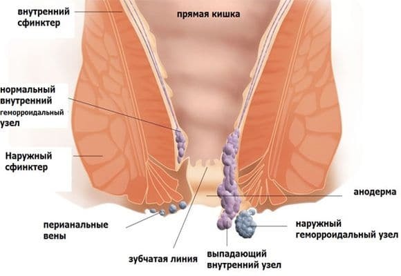 Тромбоз наружного геморроидального узла: причины и лечение