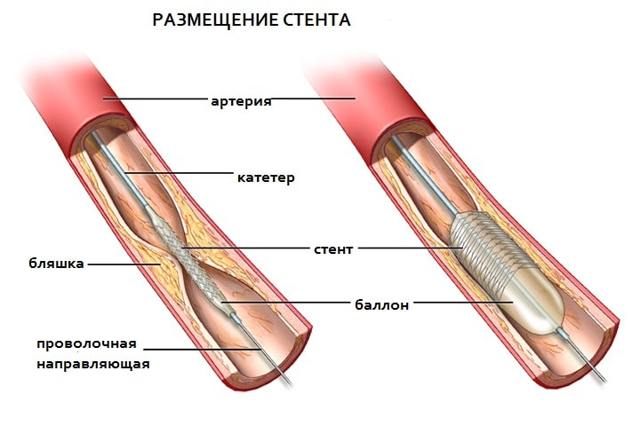 Операция после инфаркта миокарда