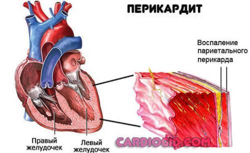 Ноющая боль в области сердца: причины и лечение