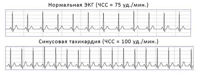 Тахикардия сердца: симптомы, диагностика и лечение - DELFI