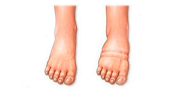 Отеки ног при сердечной недостаточности