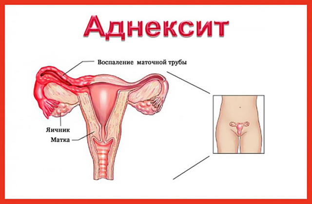 Аднексит - симптомы и лечение острой формы у женщин