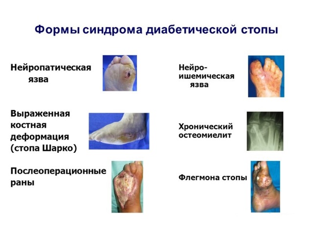 Гангрена при сахарном диабете - причины, признаки и лечение