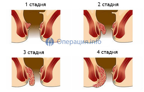Удаление геморроя - операция лазером и другие методы хирургического лечения, цена и отзывы