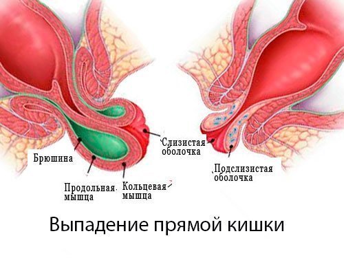 Выпадение прямой кишки: фото, симптомы и лечение