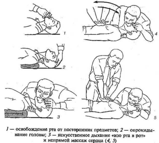 Искусственный массаж сердца и искусственное дыхание: техника проведения, правила и последовательность
