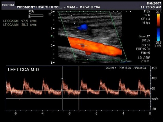 Спазмы сосудов головного мозга: симптомы, лечение, препараты, профилактика