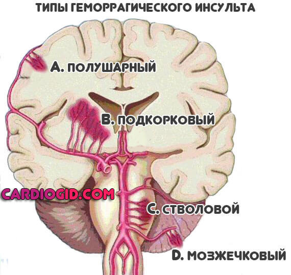 Инсульт левая или правая сторона, последствия, сколько живут