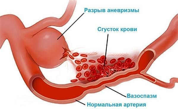 Сосуды головы и шеи: симптомы и лечение их сужения