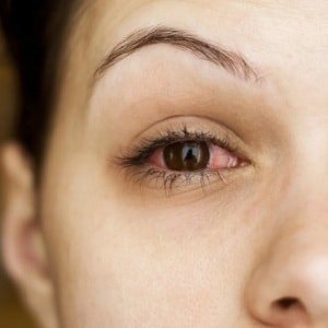 От чего лопаются сосуды в глазах: причины и профилактика