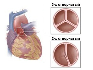 Двустворчатый аортальный клапан – врожденный порок сердца