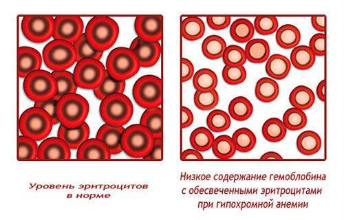 Гипохромия эритроцитов: причины и все подробности