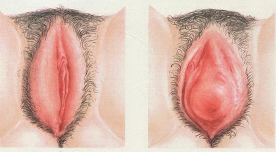 Вульвит у женщин – симптомы и лечение, фото