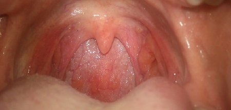 Фарингит у взрослых – симптомы и лечение фарингита у взрослых