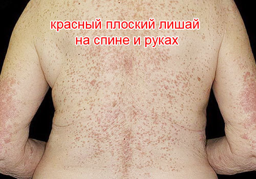 Красный плоский лишай у человека: фото, признаки и лечение