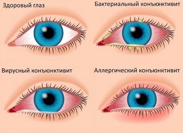 Линимент синтомицина - инструкция, применение, назначения