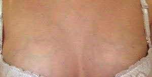 Почему видны вены на руках и как их убрать?