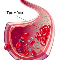 Операция по чистке сосудов нижних конечностей