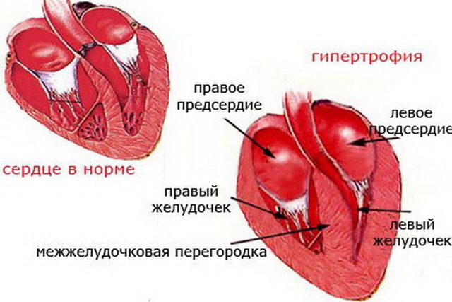 Гипертрофия левого предсердия что это такое - Всё о сердце