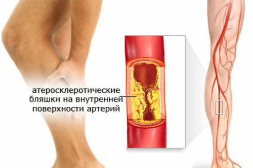 Болезни сосудов ног: причины появления и методы лечения