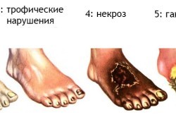 Лечение гангрены народными средствами в домашних условиях